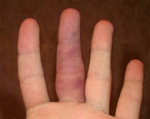 После перелома пальца на руке не могу согнуть палец
